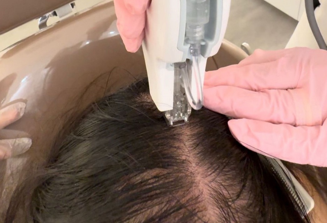 Alopecia ganha destaque após relato de Gretchen; médica explica causas e avanços nos tratamentos